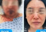 Dərman qəbulundan sonra ağır allergik reaksiya verdi - FOTO