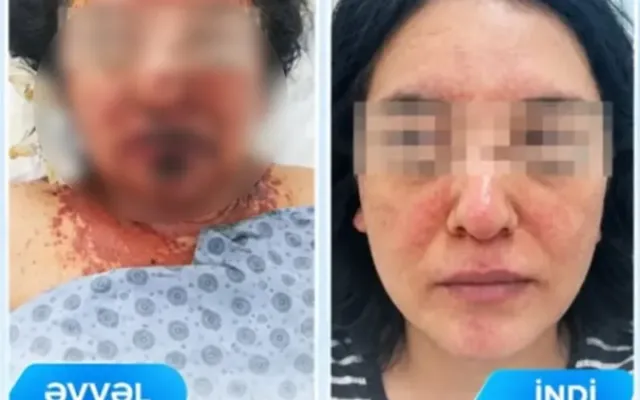 Dərman qəbulundan sonra ağır allergik reaksiya verdi - FOTO