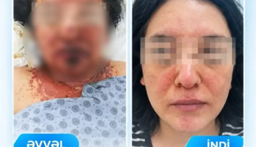 Dərman qəbulundan sonra ağır allergik reaksiya verdi - FOTO
